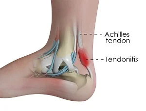 what is Achilles tendonitis?